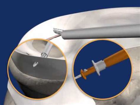 fast-fix 360 meniscal repair system